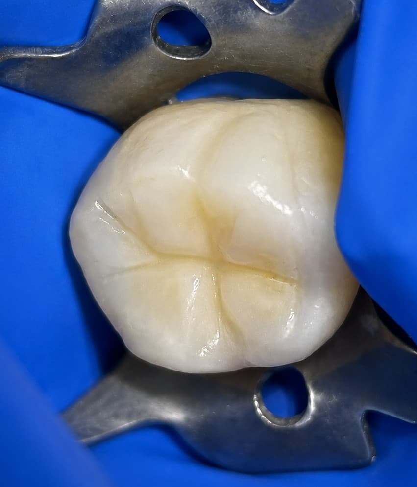 Después de restauración dental